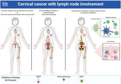 The abscopal effect of immune-radiation therapy in recurrent and metastatic cervical cancer: a narrative review